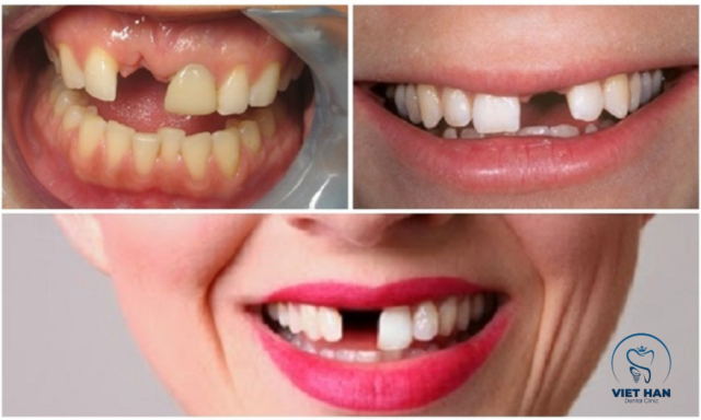 Hình ảnh trước khi trồng implant răng cửa: mất răng gây mất thẩm mỹ, ảnh hưởng phát âm và tự tin.