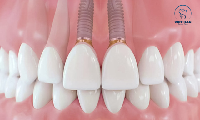 Giải pháp trồng implant răng cửa hiện đại: cố định vững chắc, bền lâu, bảo tồn xương hàm, đẹp như răng thật.