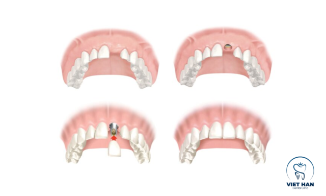 Quy trình trồng implant răng cửa chuẩn y khoa: cấy trụ – gắn abutment – lắp mão sứ hoàn thiện.