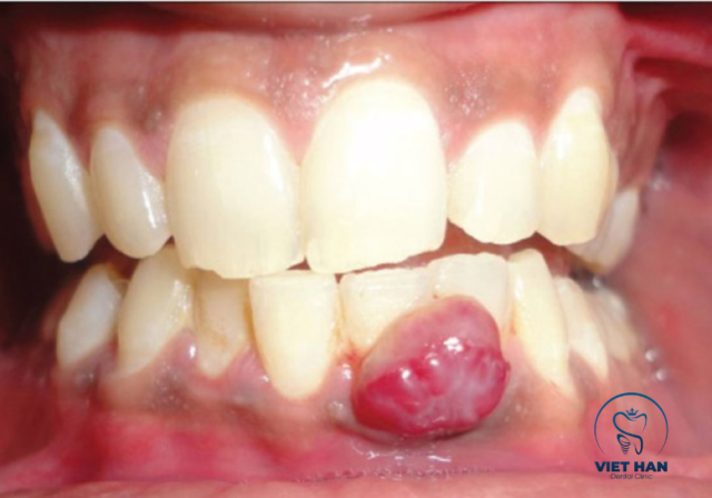 Tình trạng nướu phồng to, đỏ đậm kéo dài có thể là áp xe răng mạn tính, dễ vỡ mủ và gây hôi miệng.
