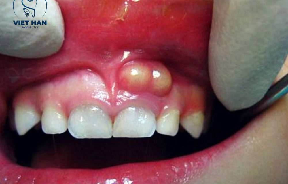 Áp xe răng: Dấu hiệu, nguyên nhân và cách điều trị an toàn