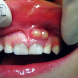 Tình trạng nướu phồng to, đỏ đậm kéo dài có thể là áp xe răng mạn tính, dễ vỡ mủ và gây hôi miệng.