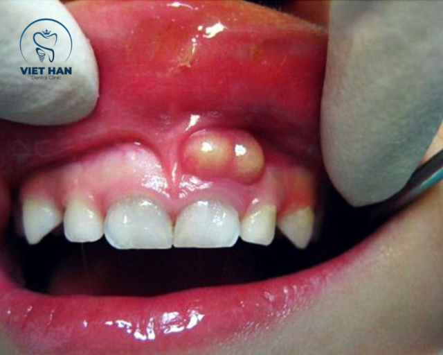 Tình trạng nướu phồng to, đỏ đậm kéo dài có thể là áp xe răng mạn tính, dễ vỡ mủ và gây hôi miệng.