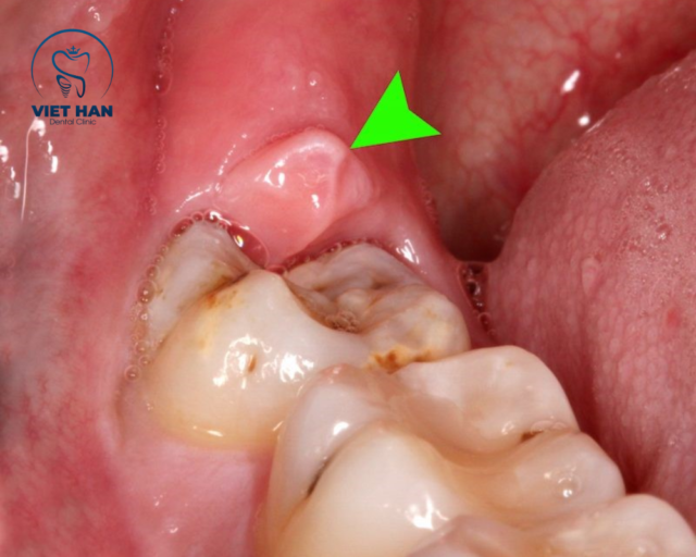 Chấm mủ trắng nhỏ trên nướu là dấu hiệu sớm của áp xe răng, thường âm thầm tiến triển và khó tự khỏi.