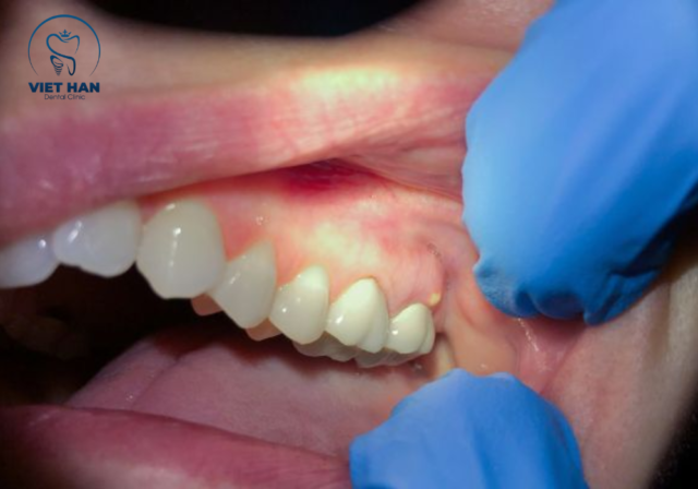 ướu đỏ, viêm lan rộng kèm đau nhức là biểu hiện thường gặp khi áp xe răng chưa được xử lý đúng cách.