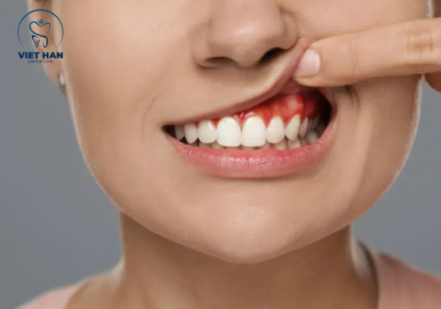 Sưng nướu khu trú, ấn đau quanh chân răng cảnh báo áp xe răng, cần thăm khám nha khoa càng sớm càng tốt.