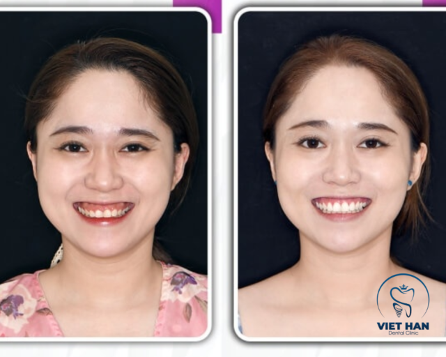 Khách hàng thay đổi diện mạo sau cắt lợi, nụ cười hài hòa, khuôn mặt tươi tắn và cuốn hút hơn.