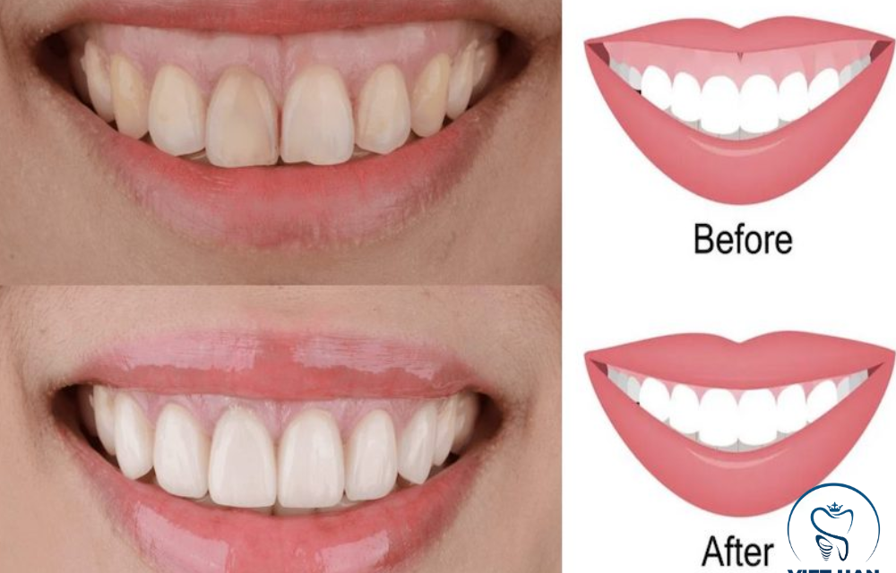 Tất tần tật những điều cần biết trước khi thực hiện cắt lợi