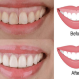 So sánh before – after cắt lợi cho thấy cải thiện rõ tình trạng cười hở lợi, mang lại nụ cười tự tin hơn.