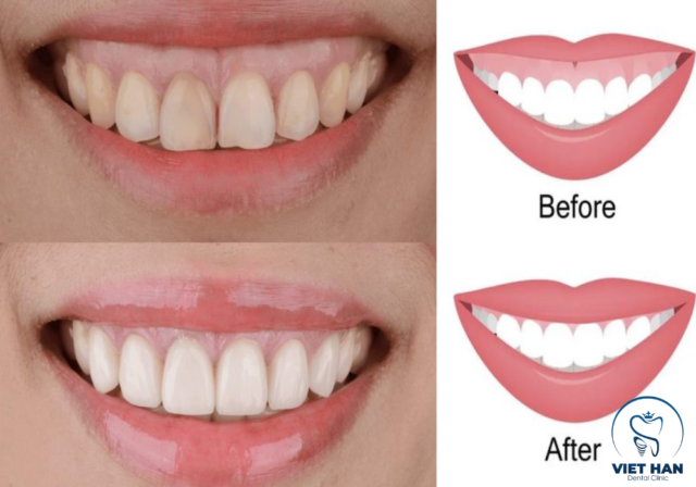 So sánh before – after cắt lợi cho thấy cải thiện rõ tình trạng cười hở lợi, mang lại nụ cười tự tin hơn.