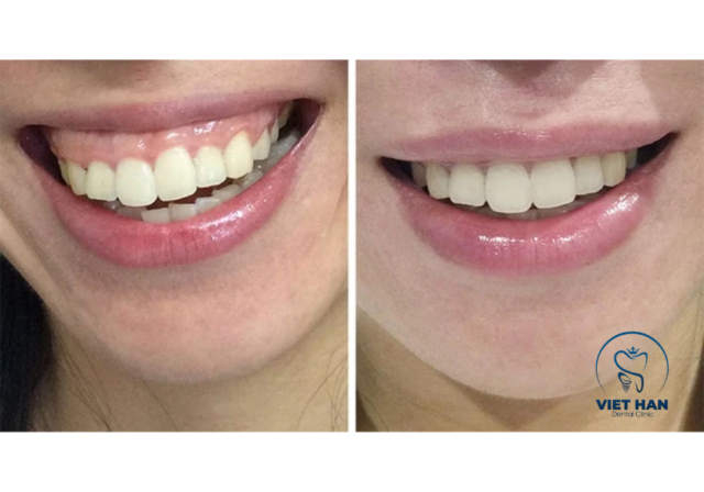 Nụ cười trước và sau khi cắt lợi giúp đường viền nướu cân đối, răng trông dài và thẩm mỹ hơn rõ rệt.