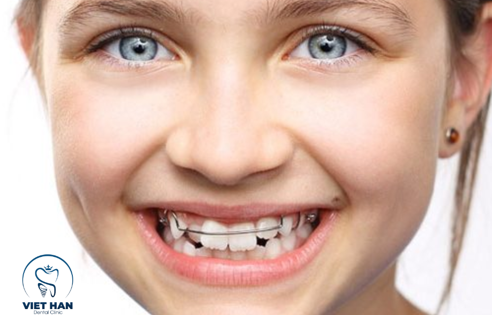 Có thể niềng răng không nhổ răng trường hợp nào?