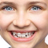 Trẻ em niềng năng không cần nhổ răng vì xương hàm vẫn phát triển.