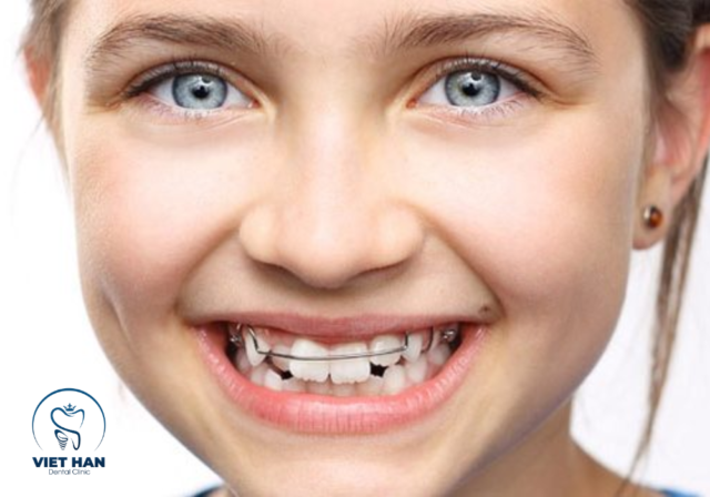 Trẻ em niềng năng không cần nhổ răng vì xương hàm vẫn phát triển.