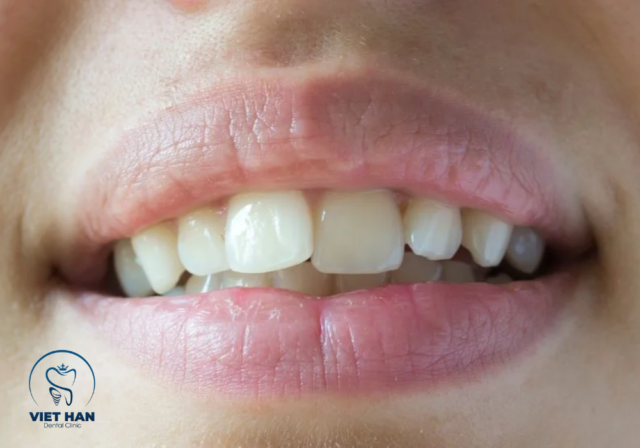 Kỹ thuật mài kẽ giúp răng lệch lạc nhẹ niềng răng không cần nhổ răng.