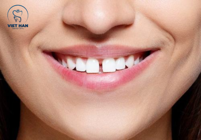 Niềng răng không cần nhổ răng đối với răng thưa vì đã có sẵn khoảng trống giữa các răng.