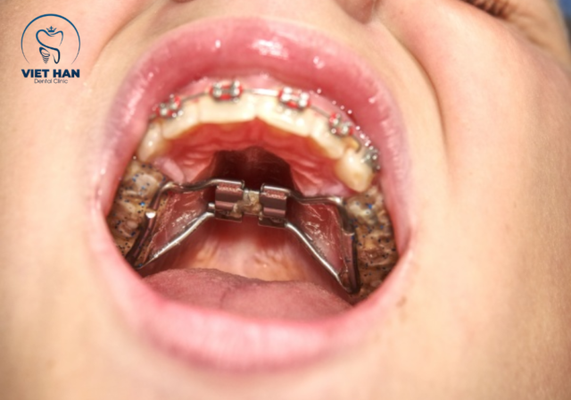 Niềng răng không nhổ răng đối với người có vòm hàm rộng.