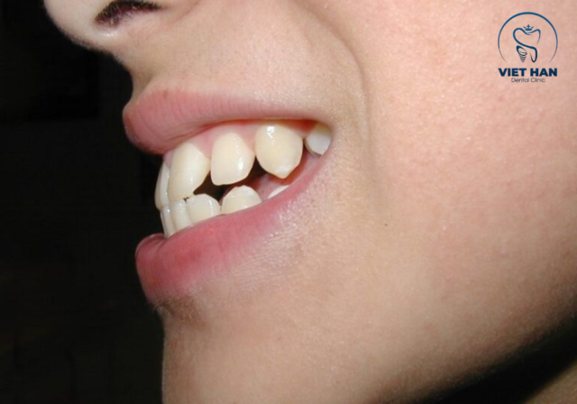 Niềng răng không nhổ răng đối với các trường hợp hô nhẹ.