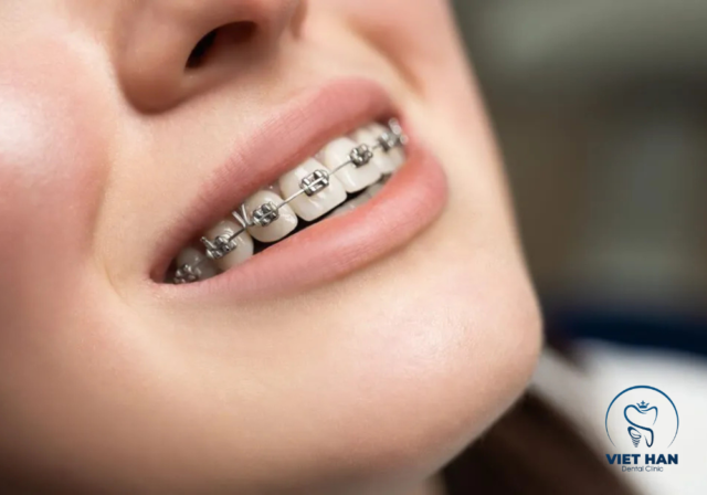 Niềng răng không nhổ răng vấn mang hiệu hàm răng đều đẹp sau niềng.