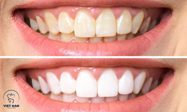 Tẩy trắng răng giúp răng trắng bật nhiều tone, men răng vẫn khỏe, nụ cười rạng rỡ hơn mỗi ngày.