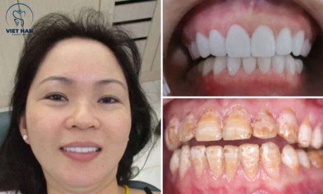 Kết quả tẩy trắng răng thực tế: răng sáng rõ, giảm ố nặng, cải thiện thẩm mỹ toàn diện.
