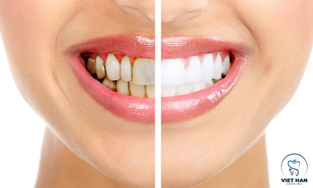 Tẩy trắng răng đúng công nghệ giúp loại bỏ mảng ố vàng, mang lại màu răng trắng đều, hài hòa.