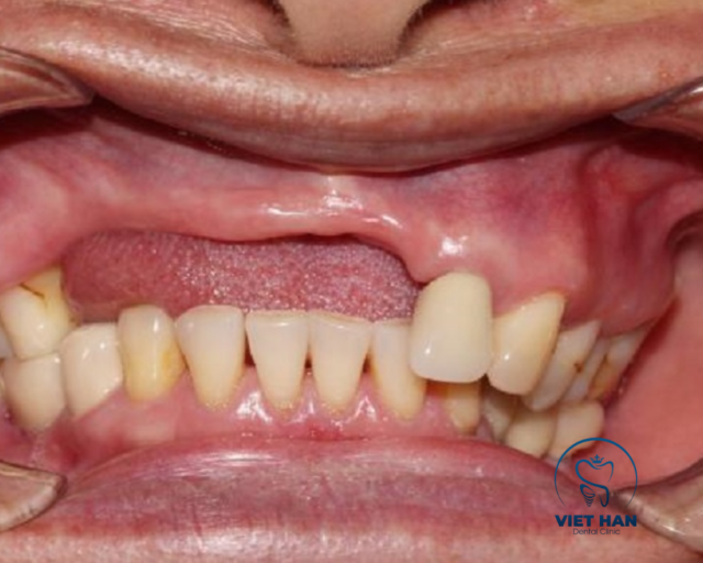 Trồng răng implant sớm giúp hạn chế tiêu xương, tụt nướu và lệch khớp cắn do mất răng lâu ngày.