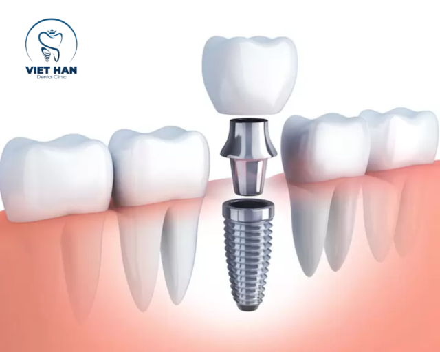 Trồng răng implant mang lại răng mới chắc khỏe, ăn nhai thoải mái và sử dụng bền lâu theo thời gian.