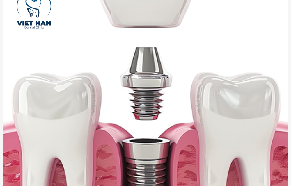 Trồng răng Implant có vĩnh viễn không? Ở đâu uy tín ?