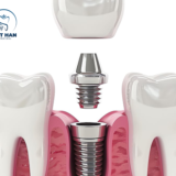 Trồng răng implant là giải pháp tối ưu thay thế răng mất, không xâm lấn răng bên cạnh.