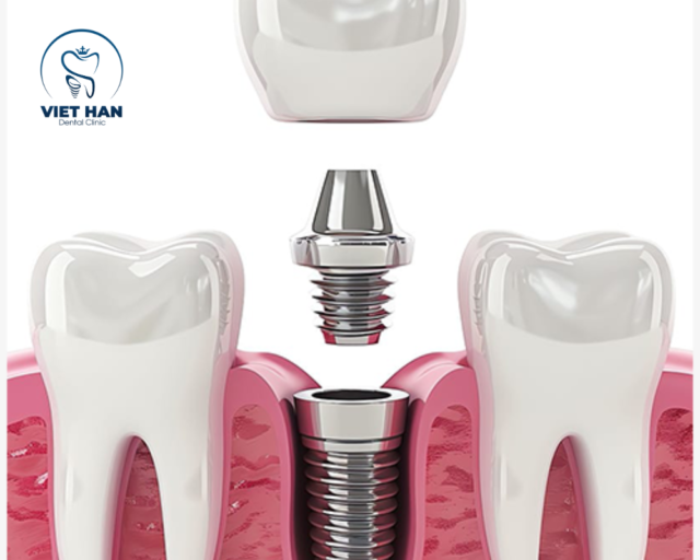 Trồng răng implant là giải pháp tối ưu thay thế răng mất, không xâm lấn răng bên cạnh.