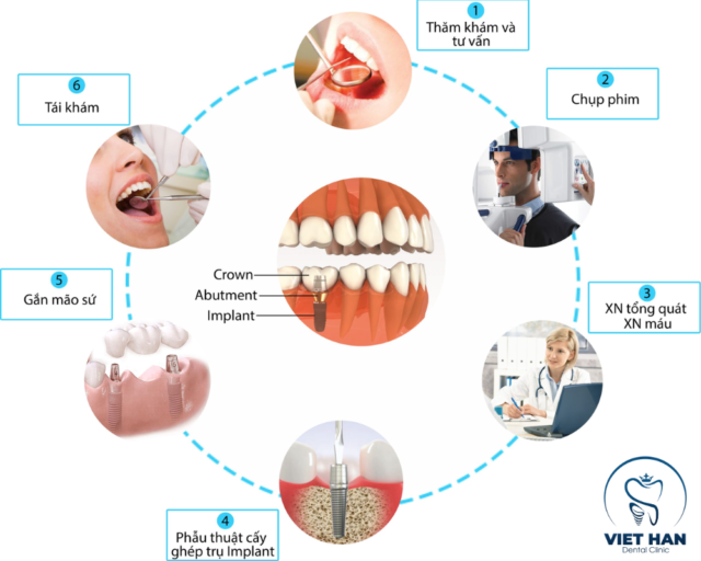 Trồng răng implant theo quy trình chuẩn: thăm khám, chụp phim, cấy trụ, gắn mão và tái khám định kỳ.