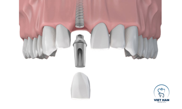 Trồng răng implant gồm trụ titan cấy xương hàm, abutment và mão sứ gắn cố định, ăn nhai bền chắc.