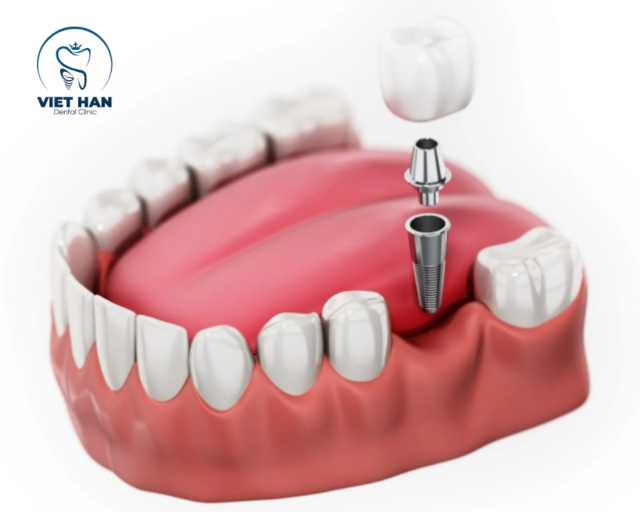 Trồng răng implant với trụ – khớp nối – mão sứ giúp phục hồi răng đã mất chắc chắn, thẩm mỹ như răng thật.