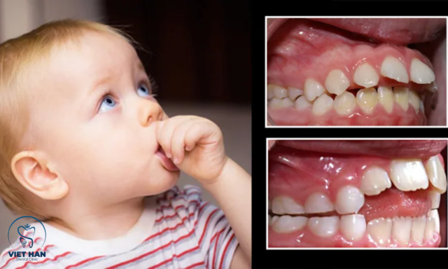 Trường hợp lưu ý đẩy tuổi niềng răng cho bé sớm hơn.