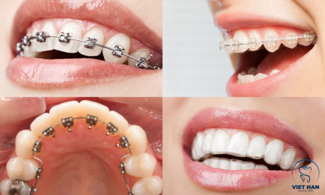 Ở tuổi niềng răng thích hợp sẽ giúp nắn chỉnh răng lệch hiệu quả và ổn định