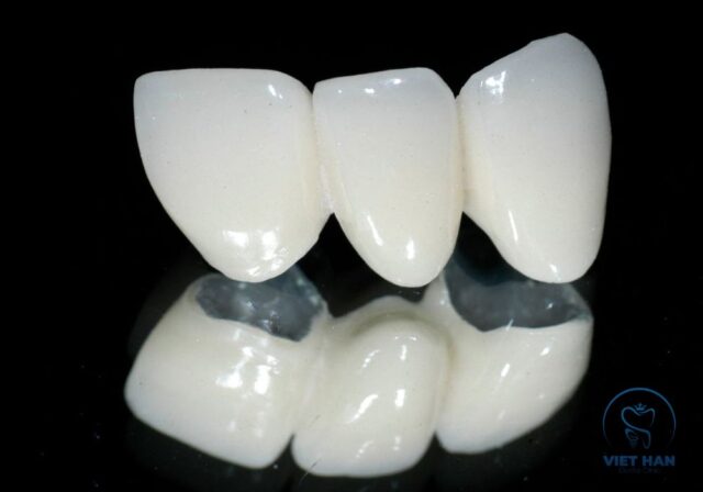 Cấu tạo lõi kim loại và lớp sứ bên ngoài giúp tăng độ bền và khả năng ăn nhai của bọc răng sứ Titan.