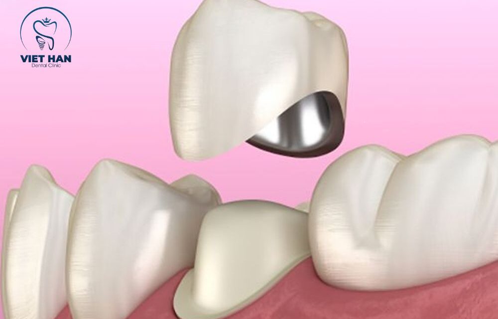 Có nên bọc răng sứ Titan không? Giải đáp chi tiết từ A-Z