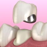 Trong các trường hợp răng hư tổn, việc bọc răng sứ titan là giải pháp phục hình phổ biến.