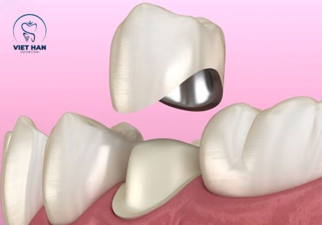 Trong các trường hợp răng hư tổn, việc bọc răng sứ titan là giải pháp phục hình phổ biến.