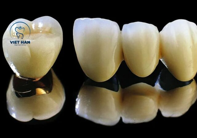 Bọc răng sứ titan là giải pháp tiết kiệm chi phí, phù hợp phục hình răng hàm cần độ bền cao.