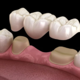 Phục hình mất răng hiệu quả với cầu răng sứ, khôi phục thẩm mỹ và khả năng ăn nhai nhanh chóng.