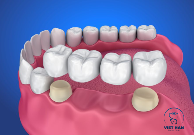 Cầu răng sứ truyền thống giúp hàm răng đều đẹp và chắc chắn hơn.