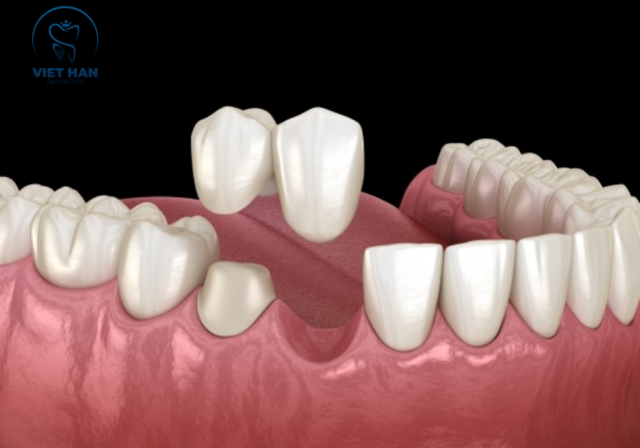 Cầu răng sứ đèo giúp lấp đầy khoảng trống mất răng, ngăn xô lệch và bảo vệ khớp cắn lâu dài.