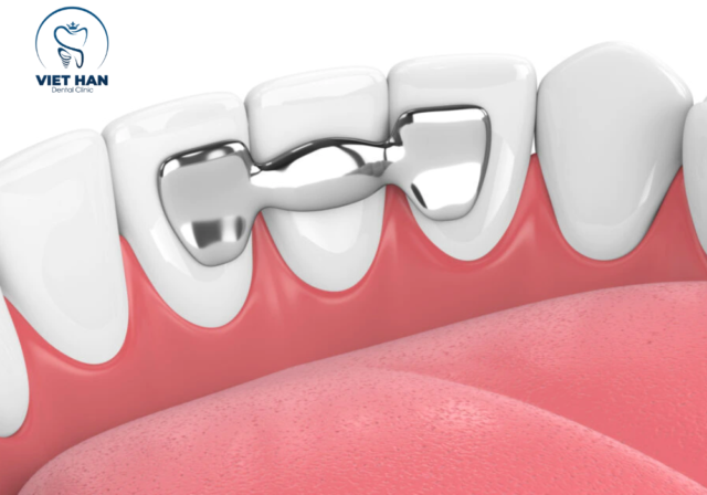 Thiết cầu răng sứ cánh dán giúp tăng độ chịu lực khi ăn nhai hằng ngày.