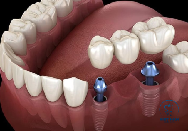 Kết hợp trụ Implant và cầu răng sứ mang lại giải pháp phục hình bền vững, thẩm mỹ tự nhiên.