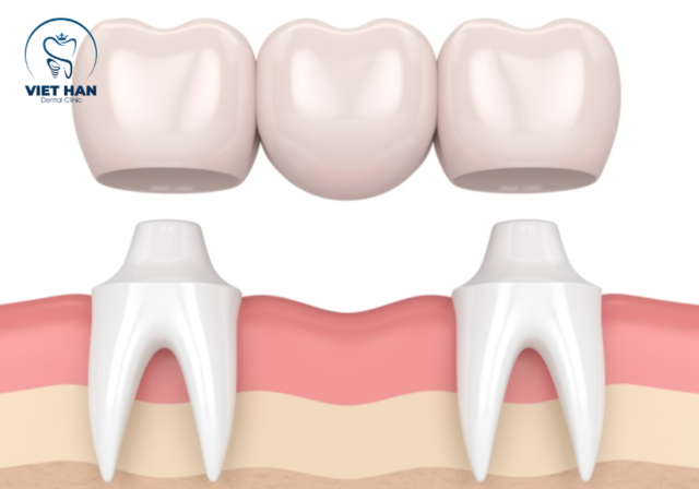 Mất răng lâu năm có thể phục hồi bằng cầu răng sứ, cải thiện chức năng nhai và sự tự tin.
