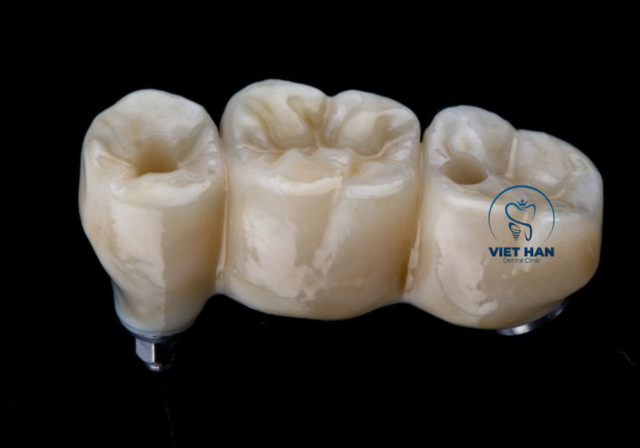 Mài răng làm trụ là bước cần thiết khi thực hiện cầu răng sứ để đảm bảo độ ôm khít và chắc chắn.