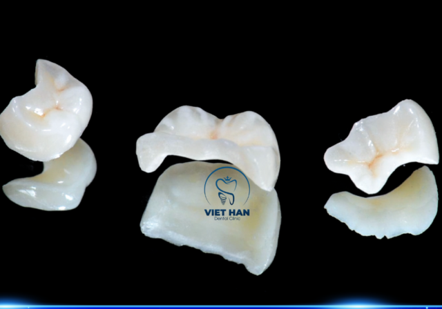 Miếng trám sứ onlay/inlay hiện đại là chất liệu trám răng giúp phục hồi hình dạng và màu sắc tự nhiên.