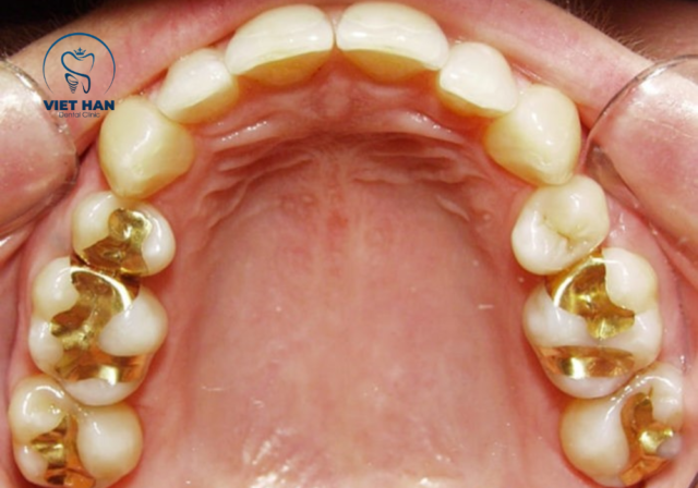 Một số chất liệu trám răng như vàng được sử dụng trong nha khoa nhờ độ bền vượt trội.